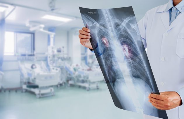 Akciğer Tomografisi (Toraks BT)