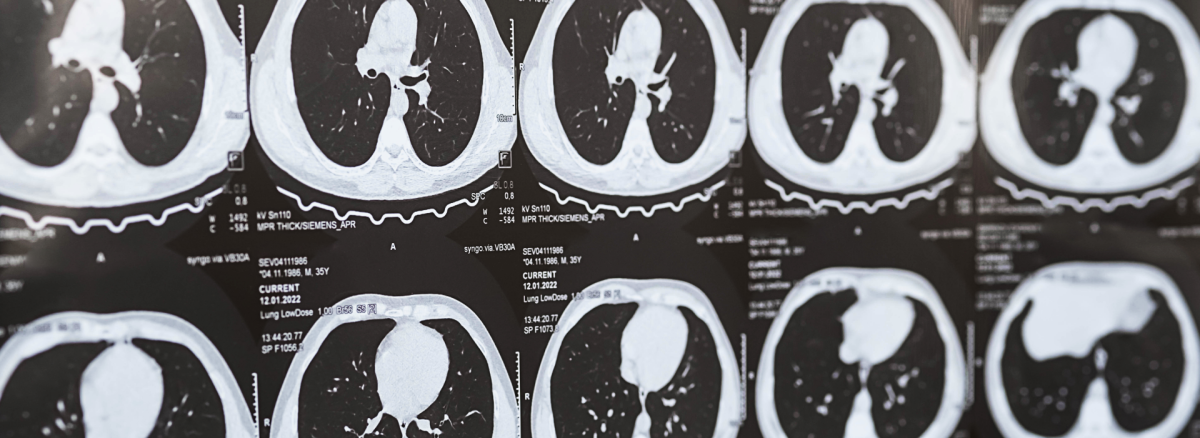 Akciğer Sertleşmesi (Pulmoner Fibrozis) Nedir? Teşhisi Nasıl Yapılır?