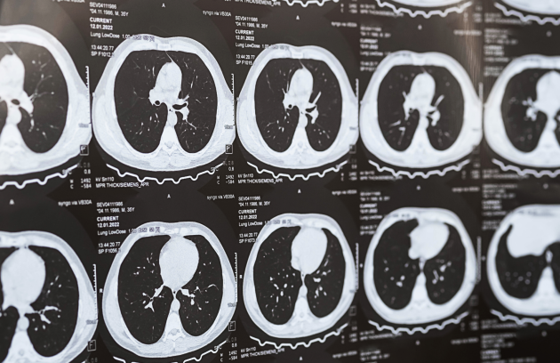 Akciğer Sertleşmesi (Pulmoner Fibrozis) Nedir? Teşhisi Nasıl Yapılır?