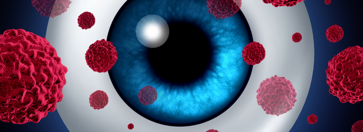 Oküler Melanom (Göz Melanomu) Nedir?