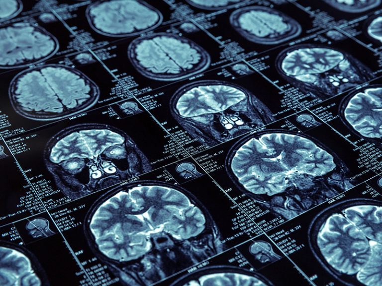 Kranial MRI